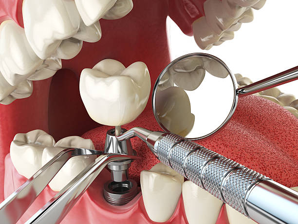 Best Urgent Care for Lost Fillings or Crowns in Big Spring, TX